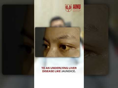 What Your Urine Color Reveals About Your Health: Dr. Subhash Chandra Bose Explains