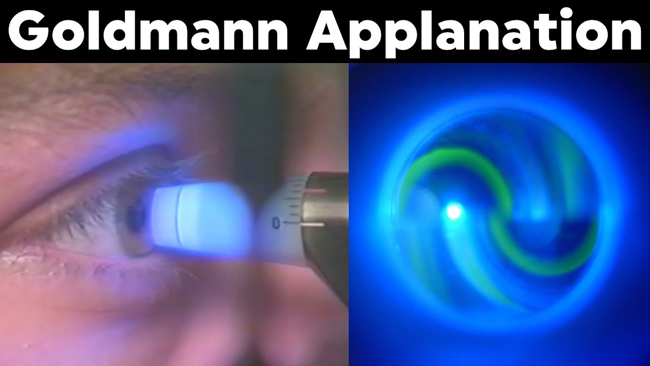 Goldmann Applanation Tonometry Procedure Technique Tutorial