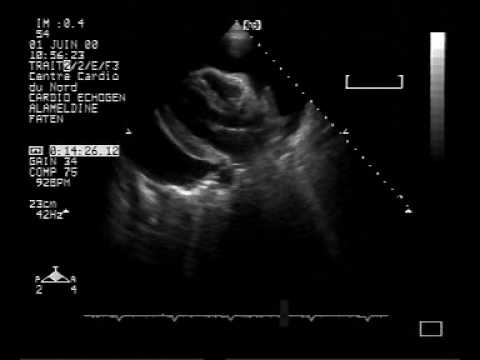  Massiver Perikarderguss mit Herztamponade