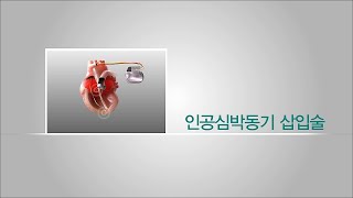 인공심박동기삽입술 미리보기