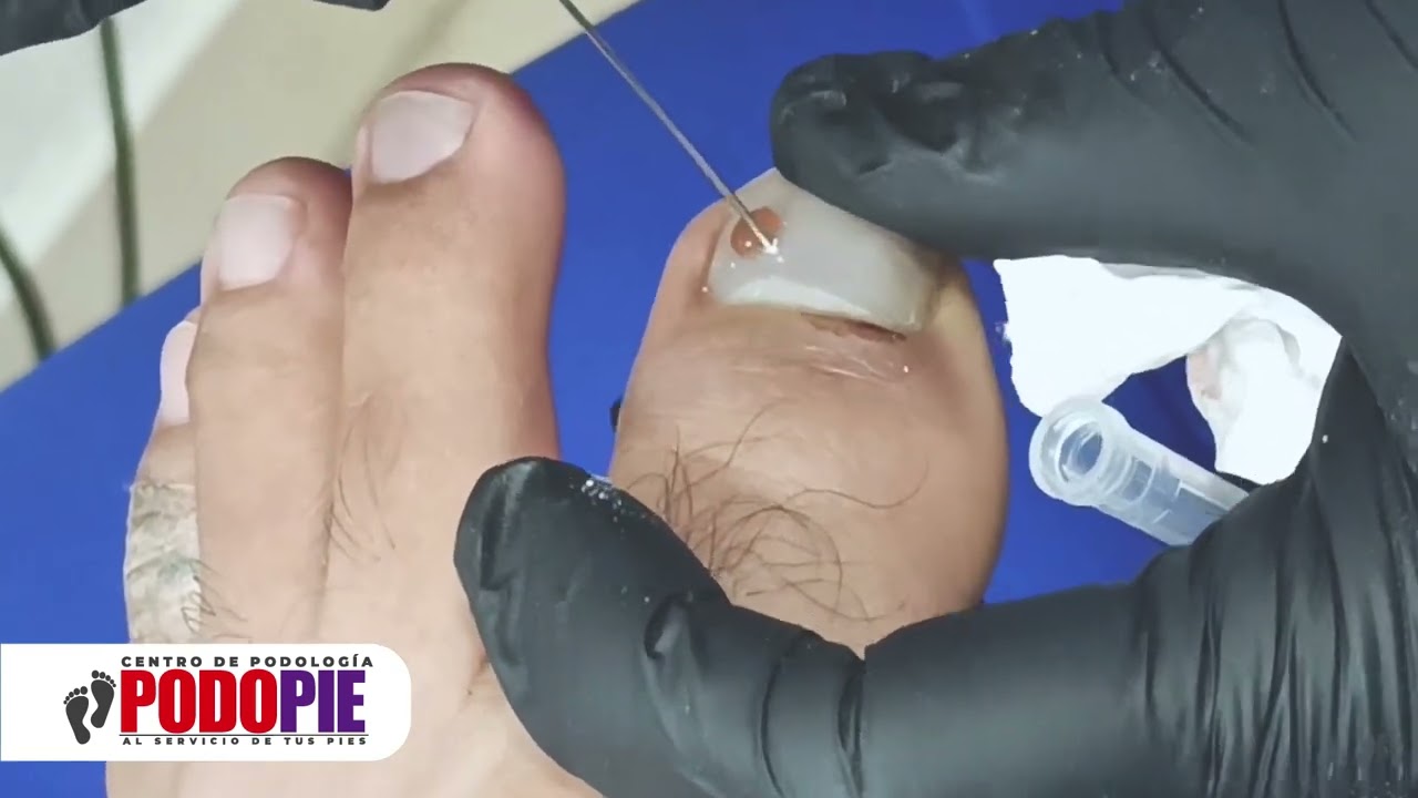 DRENAJE DE HEMATOMA EN UÑA Traumatismo por golpe