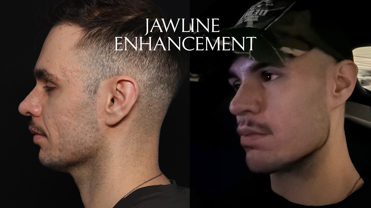 Male jawline enhancement with custom PEEK implants, patient journey with Dr. Zelken