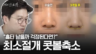 “콧볼축소+울퉁불퉁한 콧대라인 교정 했어요” 티 안 나는 자연스러운 변화 | 최소절개 콧볼축소 3개월 케이스리뷰