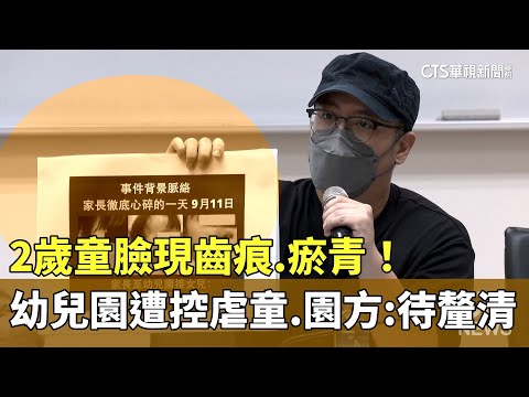 2歲童臉現齒痕.瘀青！　幼兒園遭控虐童　園方：待釐清