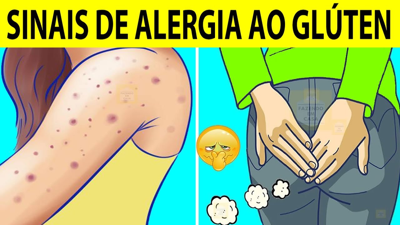 6 Sinais de INTOLERÂNCIA AO GLÚTEN Que Muitos Ignoram