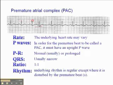 ECG: Premature Atrial Complex