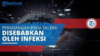 Skleritis, Peradangan Sklera Disebabkan Adanya Penyakit Auto-imun, Infeksi Bakteri, dan Jamur