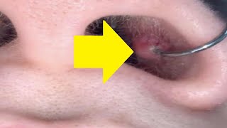 how to get rid of a piercing bump inside your nose fast and easy