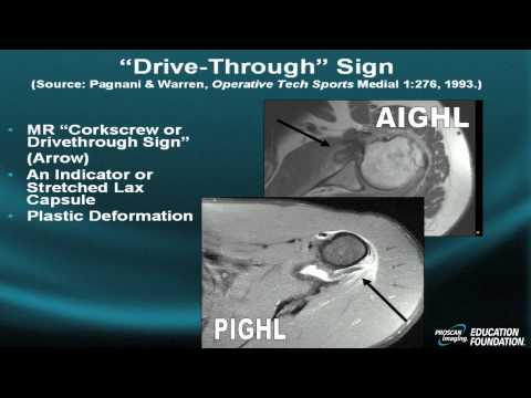 Shoulder MRI: Instability, Part VI