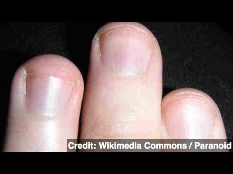 Hope for Human Limb Regeneration Could Lie in Fingernails