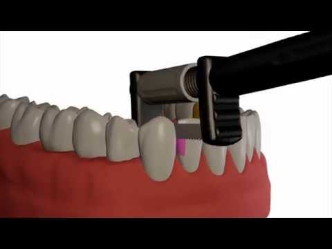 Strauss Diamond Magic Strips