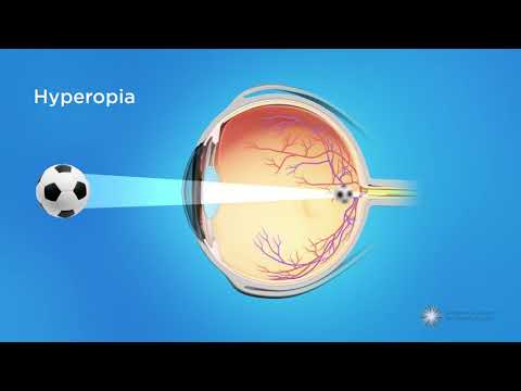 What is Hyperopia (Farsightedness)?