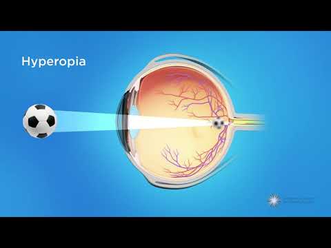 strabismus hyperopia homeopátia)