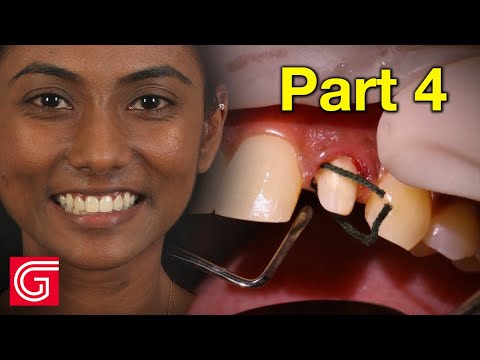 HOW TO Deliver Zirconia Crowns on ANTERIOR Teeth