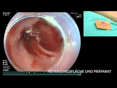 Behandlung von Prostata-Verkalkung Behandlung von Prostatitis Ferse