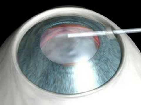 download lagu mp3 mp4 Icl Surgery, download mp3 Icl Surgery free download, download mp3 Icl Surgery