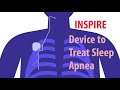 INSPIRE Device to Treat Sleep Apnea