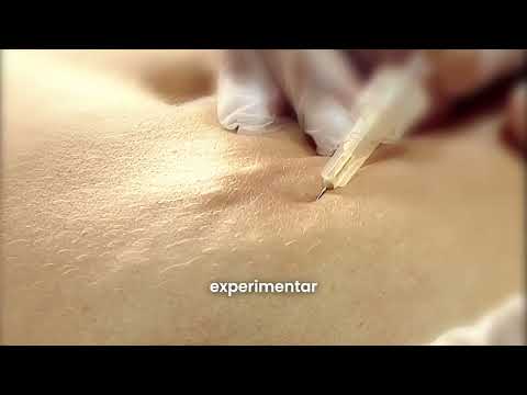 Carboxiterapia - Elimina la celulitis - Dario Cabello en Barranquilla
