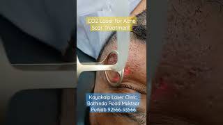 Clear, Smooth Skin is Possible with CO2 Laser Acne Scar Treatment, CO2 Laser for Acne Scar Treatment