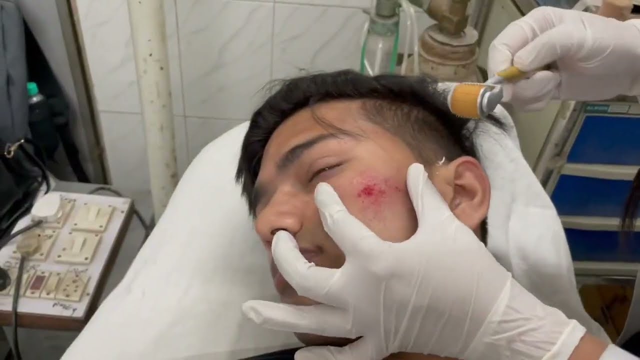 Dermaroller (1.5 mm) procedure (Dr Bhawuk Dhir)