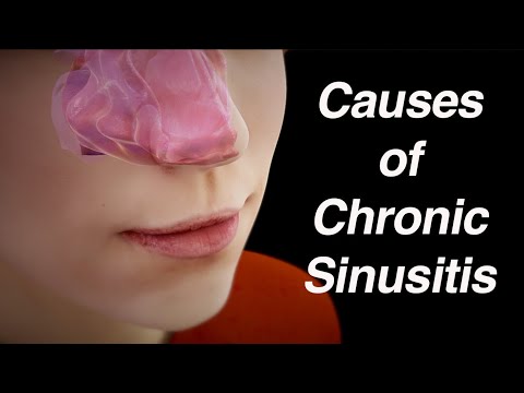Causes of Chronic Sinusitis (Anatomic Factors, Biofilm, Abnormal Microbiome)