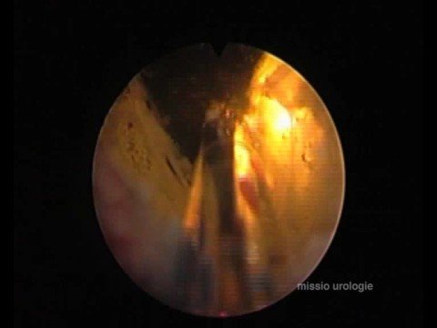 Prostata PSA Ergebnisse Prostata-Adenokarzinom Grad 2