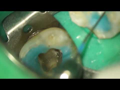 Calcification removal using ultrasonic