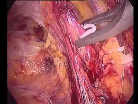 download lagu mp3 mp4 Shailesh Puntambekar Pune Technique, download lagu Shailesh Puntambekar Pune Technique gratis, unduh video klip Shailesh Puntambekar Pune Technique