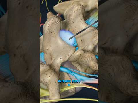 Lumbar Epidural Steroid Injection (3D Animation)
