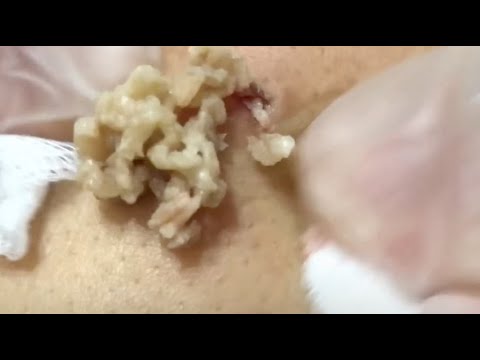 Popping a large CYST