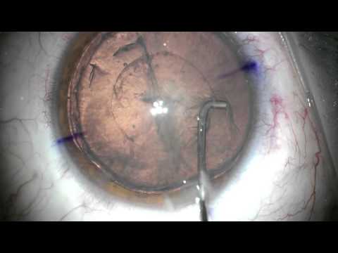 Hydrodissection and Hydrodelineation in Patient with Megalocornea
