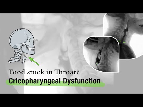 Cricopharyngeal Dysfunction: Before and After Cricopharyngeal Myotomy