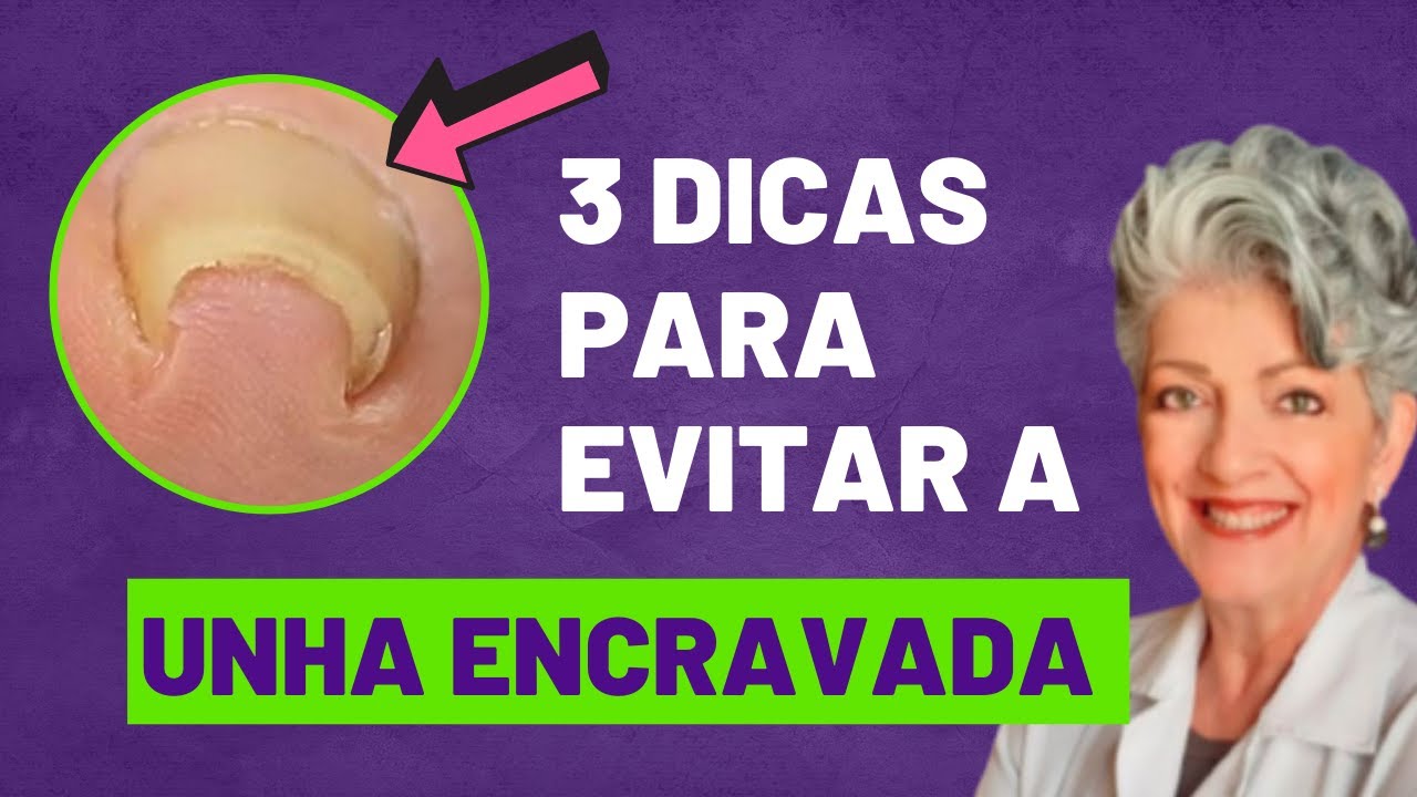 3 DICAS INFALÍVEIS para evitar a UNHA ENCRAVADA