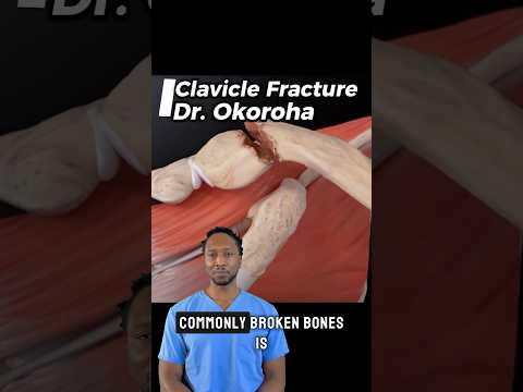 💥 Clavicle Fracture? Here’s How We Fix It. 🛠️🦴 #shorts