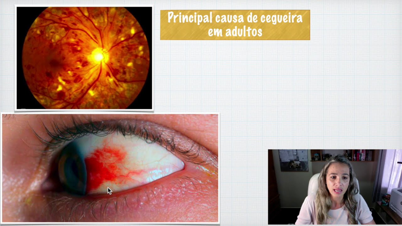 Complicações Crônicas Microvasculares do Diabetes Mellitus