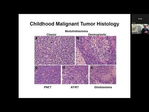 Neurodevelopmental Origin of Childhood Central Nervous System Tumors