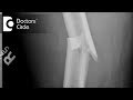 How long does it take to recover from a Complex fracture? - Dr. Gururaj S Puranik