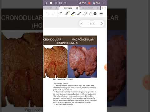 Patho lec 3 - doença hepática 1 (pt.3) + doença hepática 2