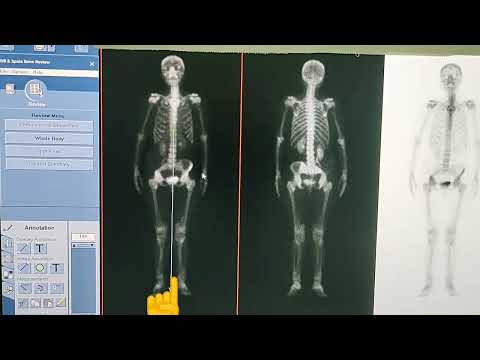 COMO AVALIAR UMA CINTILOGRAFIA ÓSSEA