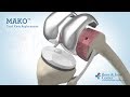 Full Knee Replacement | Mako Robotic Arm Assisted Surgery Technology