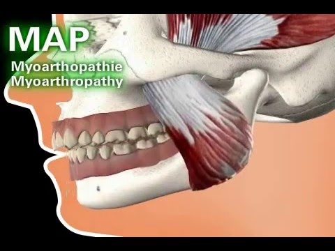 Wie viel ist die Behandlung von Bandscheibenbruch Arthrose des Kniegelenks von 2-3 Grad Drogen