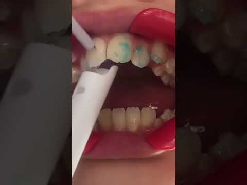 LIGHTFORCE BRACES‼️✨#shullmanorthodontics #reels