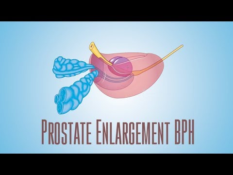 A prostatitis vizelet rossz