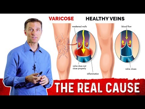 What Causes Varicose Veins & How To Get Rid Of It? – Dr. Berg