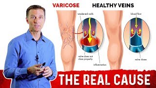 What Causes Varicose Veins & How To Get Rid Of It? – Dr. Berg
