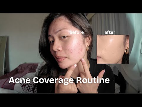 How to Cover Acne Marks Step by Step ✨ Primer, Concealer & Foundation