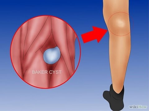 Cómo deshacerse de la enfermedad degenerativa del disco cervical sin pastillas Dolor en el lado izquierdo en la parte inferior de la cintura trasera