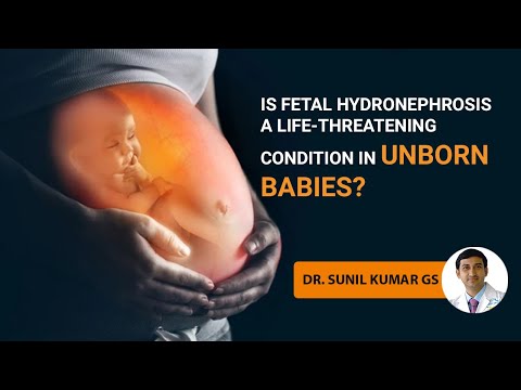 Is fetal hydronephrosis a life-threatening condition in unborn babies? |Dr. Sunil Kumar G S|#unborn