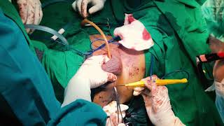 Total Penectomy and Perineostomy