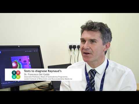 What are the tests to diagnose Raynaud's?